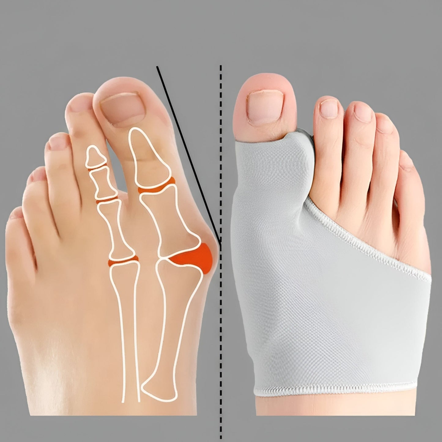Attelle Orteil Hallux Valgus | Posturovia